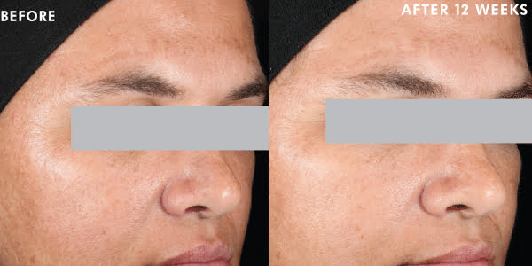 DISCOLORATION DEFENSE | Before & After Image | Suvita Medical Aesthetics | Wall Township, NJ