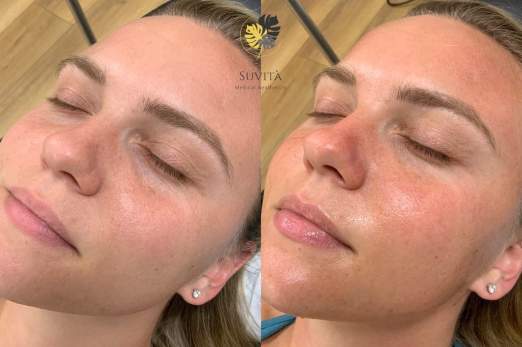 Woman Face Before & After Images | Suvita Medical Aesthetics | Wall Township, NJ