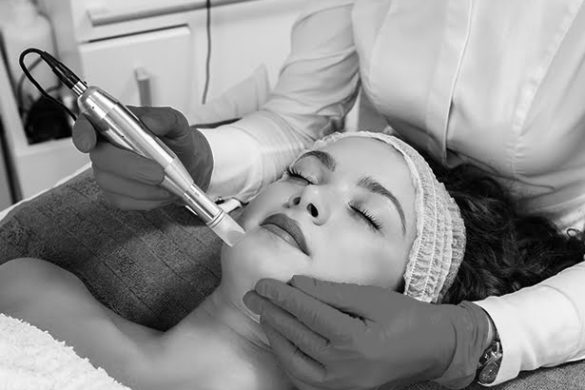 Collagen Induction Therapy With Microneedling Matawan NJ