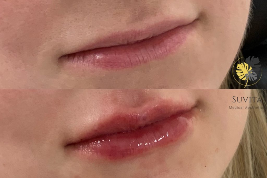 Woman Lips Before & After Images | Suvita Medical Aesthetics | Wall Township, NJ