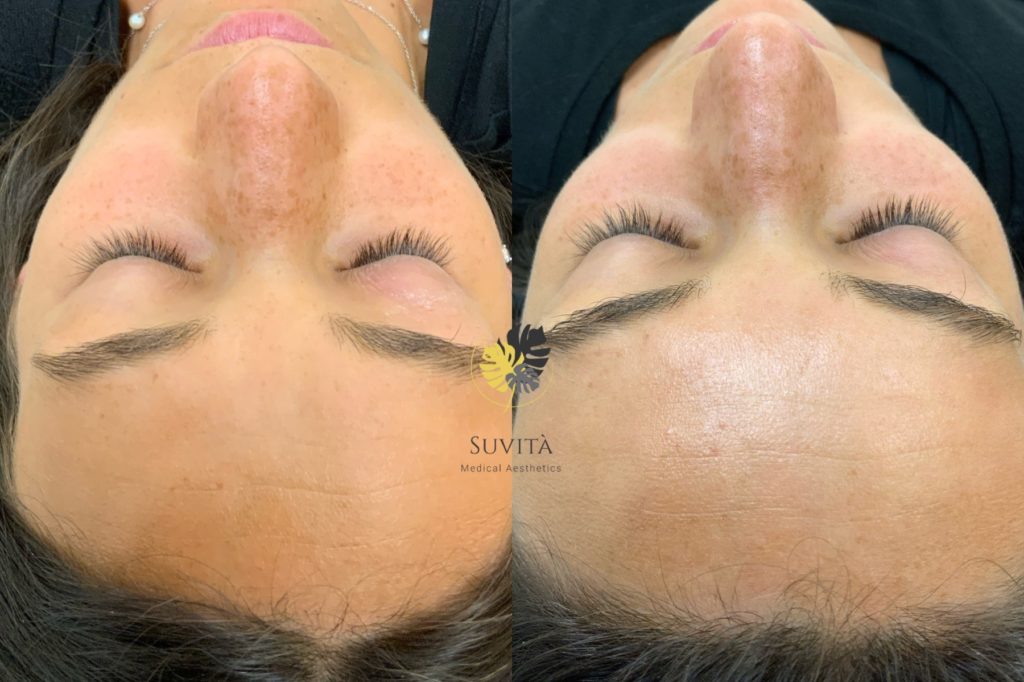 Woman Face Before & After Images | Suvita Medical Aesthetics | Wall Township, NJ